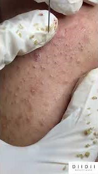 squeeze acne and relax 12