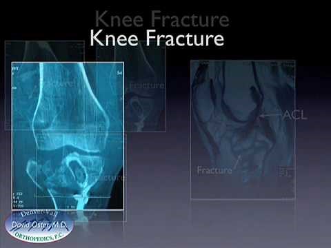 Treatment of a Knee Fracture (Tibial Plateau) in a Patient with an ACL Reconstruction