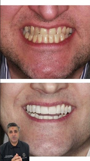 Underbite Correction with Porcelain Onlay and Veneers | Natural Smiles Leicester