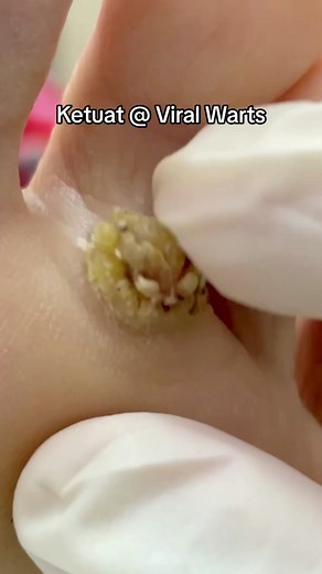 Ketuat @ Viral Warts: Fakta Penting & Rawatan Terkini