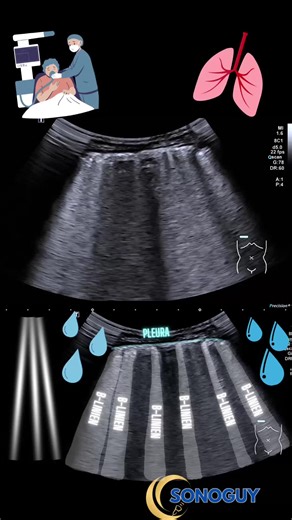 Understanding B-Lines in Lung Ultrasound Imaging