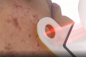 AviClear Acne Laser Treatment | Before & After Pictures