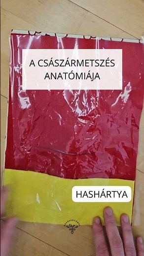 A császármetszés anatómiája: így zajlik a műtét, így jutnak el a babáig