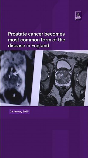 Prostate cancer most common cancer