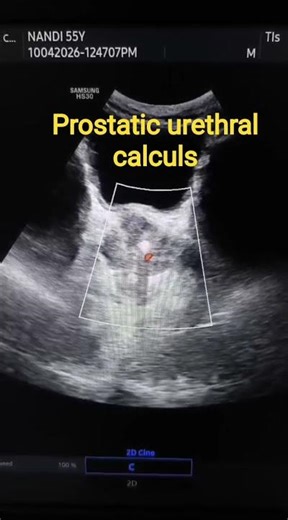 prostatic urethral calculs