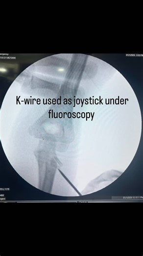 Dr Kamlesh Devmurari on Instagram: "Joystick Technique for Radial Neck Fracture in Children Radial neck fractures in children require accurate reduction to restore normal elbow movement. Using a percutaneous K-wire as a joystick, the fracture can be reduced without opening the joint under C-arm guidance. 🔹 Why this technique? ✔ No skin incision ✔ Minimal soft tissue damage ✔ Precise fracture control ✔ Faster recovery ✔ Excellent functional outcome This minimally invasive, child-friendly techniq