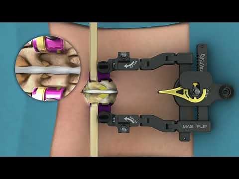 Nuvasive: MAS PLIF