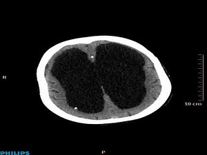 hydrocephalus ct