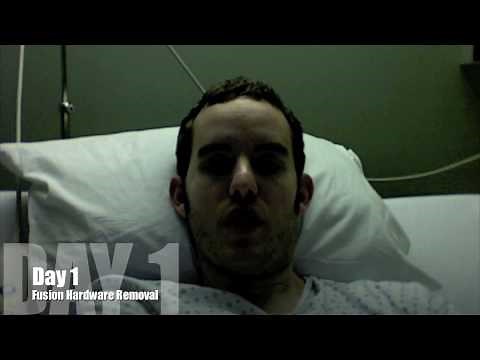 Fusion Hardware Removal