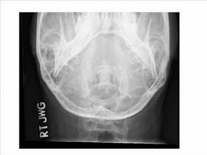 Fuchs Method -Dens.wmv