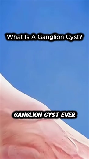 What is a ganglion cyst? | what is a ganglion cyst