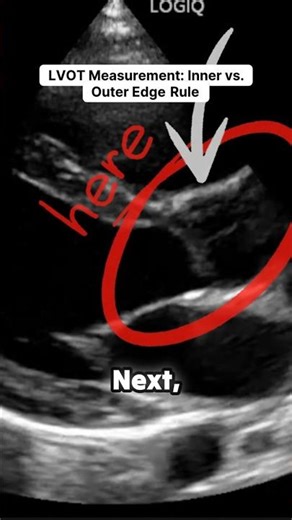 🫀⚠️ LVOT Measurement Mistake Most Sonographers Make