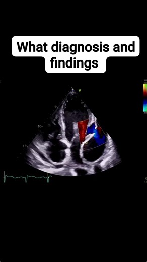 What diagnosis and findings in Echocardiography findings Large pseudoaneurysm (90x53x73 mm) in chronic covered rupture of the left ventricular base posterolaterally with significant persistent shunt. Patient after car accident polytrauma years ago. 🟢 Answer Case 32 🟢 👇👇👇👇👇https://t.me/EchoNotadvanced | د.جمال العزب