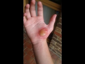 FX Makeup: Blisters