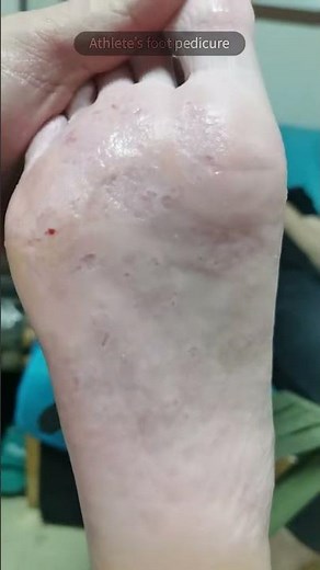 A trick for relieving itching from athlete's foot #athletesfoot #relax #foot #pedicure #satisfying