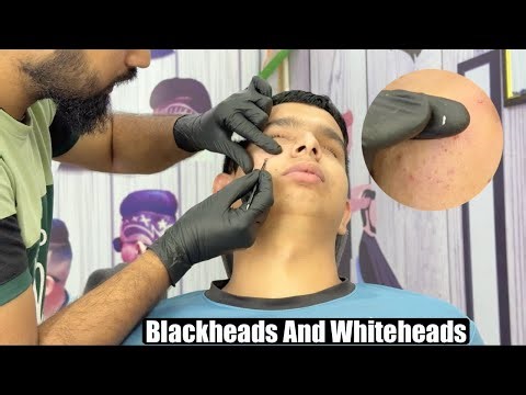 How to remove blackheads | How to remove black heads white heads at home | How to remove whiteheads