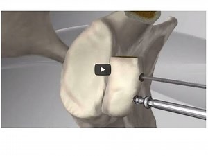 Latarjet Stabilisation