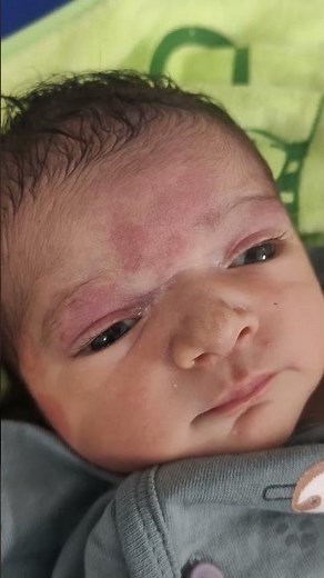 Red patches on baby's face | Birth mark on baby's face #baby