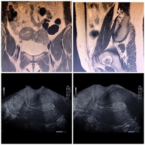 MIOMAS (FIBROMAS) CERVICALES (EN EL CUELLO DE LA MATRIZ). * Un mioma cervical puede sangrar, infectarse, dificultar la micción o bien, causar dolor durante las relaciones sexuales. Los miomas son tumores benignos formados por tejido muscular y rara vez se forman en el cuello uterino. Los miomas cervicales, grandes, pueden bloquear las vías urinarias o proyectarse a la vagina. A veces, se desarrollan úlceras en miomas prolapsados, los cuales pueden infectarse, sangrar o ambas. Extraordinariamente