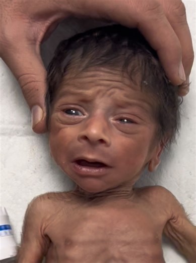 Understanding Malnutrition in Newborns: Causes and Solutions