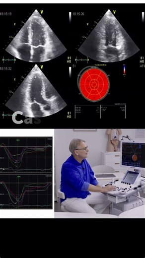 What does global longitudinal strain actually measure?