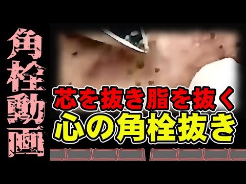 【 角栓抜き動画 】芯を抜き脂を抜いて心のデトックス。Detox your mind by removing the core and removing the fat.