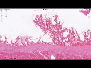 Fibrinous Pericarditis - Histopathology