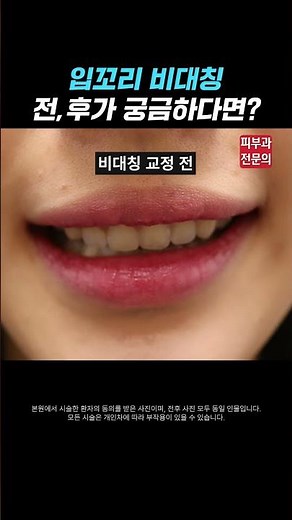 삐뚤어진 입술 이렇게 교정 할 수 있습니다ㅣ입술 비대칭 교정, 입술 비대칭 보톡스, 필러, 입꼬리 비대칭 교정, 입꼬리 보톡스 후기, 동대문 피부과, 청량리 피부과