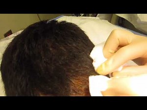 Scalp Abscess