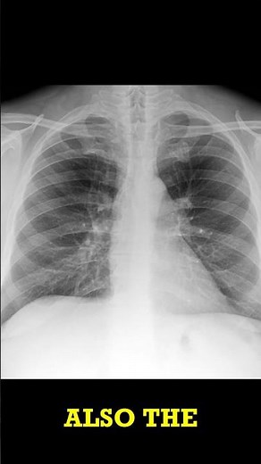Chronic Bronchitis on Chest X-Ray Quick Radiology Short
