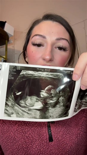 Understanding NIPT Testing Results for Gender Reveal