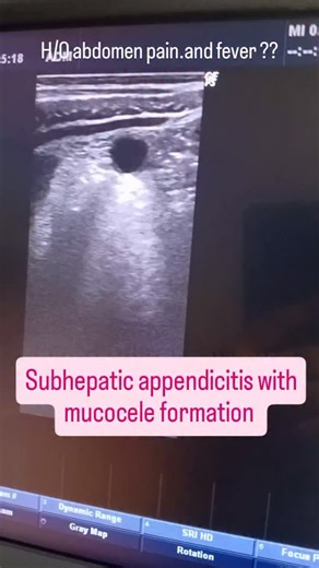 RadDrAzCheema on Instagram: "🔍 Case Highlight: Subhepatic Appendicitis with Mucocele Formation Ultrasound isn’t just about gallbladders and livers—sometimes it reveals the unexpected. 👉 In this case, the appendix was found in a subhepatic position, mimicking hepatobiliary pathology. 👉 Ultrasound showed a cystic, tubular structure with internal echoes, consistent with appendiceal mucocele. 👉 Recognizing this rare presentation is crucial—misdiagnosis can delay surgical intervention. ✨ Key Take