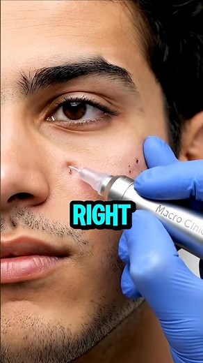 This "Blackhead" Was a HIDDEN BOMB About to EXPLODE Next to His Eye!