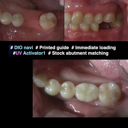 Restoring a Molar with a Dental Implant