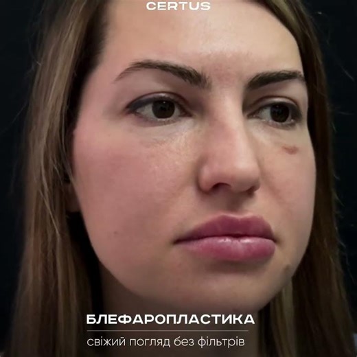 Результат блефаропластики | До і після пластики повік у клініці Certus