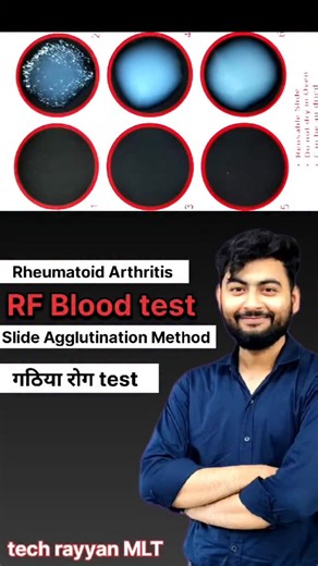 Rayyan Alam on Instagram: "RF Test Kya Hota Hai? Gathiya Rog Ka Sabse Asaan Lab Test Explained!”Rheumatoid arthritis||#labtechnician #arthritis"