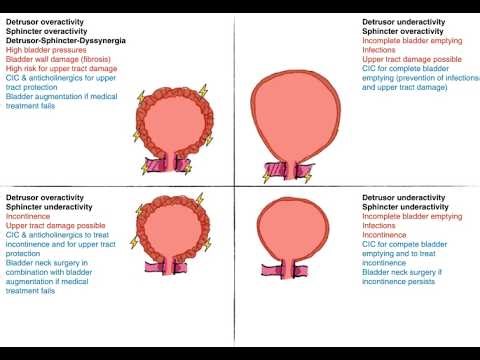 Detrusor sphincter dyssynergia; bladder’s detrusor muscle And external urethral sphincter fail