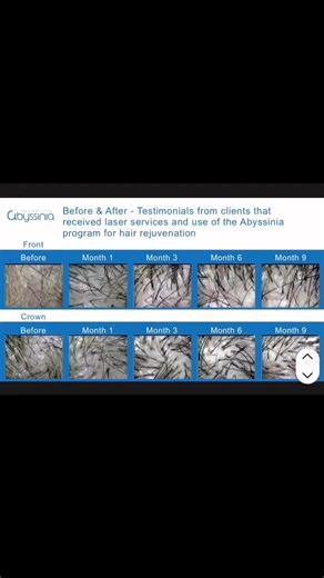 Low-level laser therapy works by stimulating a natural process in the cells of hair follicles. ……………………………………1. Stimulates cellular energy: The laser emits specific wavelengths of light that are absorbed by the mitochondria in hair follicle cells. This increases the production of adenosine triphosphate (ATP), the energy that powers cellular function. 2. Increases blood circulation: The energy from the laser also enhances blood flow to the scalp. This delivers more oxygen and nutrients to the hai