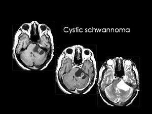 Radiology - Imaging of the Posterior Fossa & its Lesions