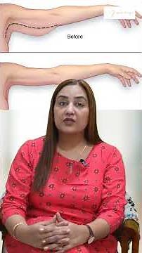 Brachioplasty Recovery Explained | What to Expect After Arm Lift Surgery