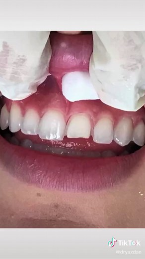 Correcting 1 Front Tooth with Porcelain Veneers | Dr. Yazdan