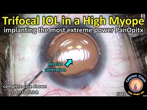the most extreme Alcon PanOptix IOL power (cataract surgery in a highly myopic patient)