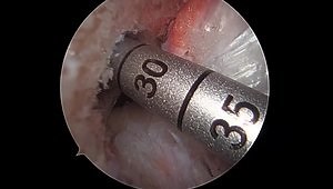 Quadriceps Tendon ACL Reconstruction using Quad-Specific Fixation