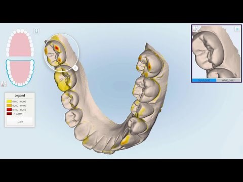 How to use iTero™ TimeLapse technology | iTero scanner training