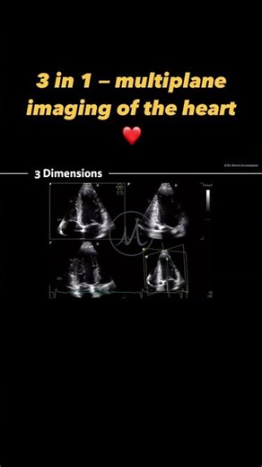 Multiplane imaging in #echocardiography