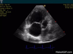 Echocardiogram Cor Pulmonale, PHTN, Pulmonary Hypertension. on Make a GIF