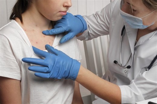 CDC warns measles cases may rise as travel increases