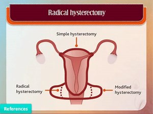 13K views | When is a simple, radical or modified hysterectomy...