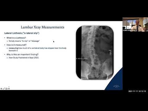 When should you have surgery for adult onset scoliosis?