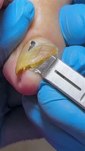 Sharp yellow inlays! Silky trimmings #nails #pedicure
